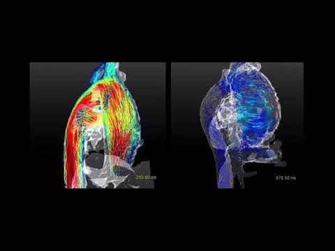 Künstliche Intelligenz beschleunigt MRI des Blutflusses