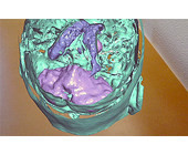 hololens-neurosurgery-3d.jpg